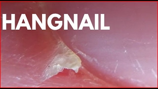 Hangnail [upl. by Monaco]