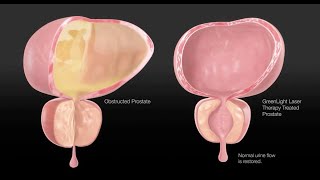 How to SHRINK Enlarged Prostate amp Lower PSA Levels Naturally  Avoid Prostate Reduction Surgery [upl. by Hgiel]