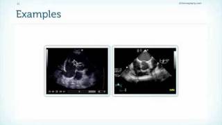 Tricuspid Valve Endocarditis in Echocardiography [upl. by Desimone]