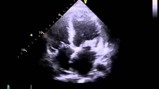 Echocardiography to Assess MitralValve Leaflets  NEJM [upl. by Eitnom584]