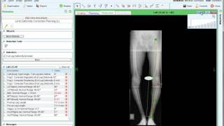 Weil Osteotomy Performed by Dr Paul Steinke [upl. by Seth]