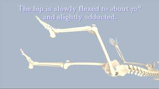 Hip Dislocation [upl. by Fidelity92]