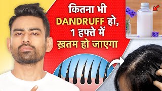 Dandruff का Permanent Solution at Home For Men amp Women [upl. by Athallia]