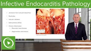 Infective Endocarditis IE Pathology – Infectious Diseases  Lecturio [upl. by Iel]