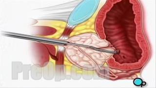 BPH 3  surgical treatment for prostate enlargement [upl. by Herc63]