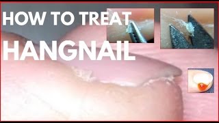 How to treat hangnails Agnail treatment [upl. by Derron]