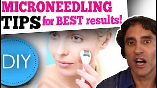 MICRONEEDLING DIY at HOME  What You Need to Know [upl. by Ashelman]