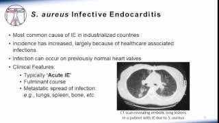 Endocarditis Microbiology and Treatment [upl. by Naleag]