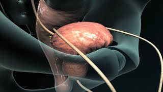 Prostate Enlargement Benign Prostatic Hyperplasia  BPH  Dr Gary Sy [upl. by Atilal190]