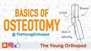 Minimally Invasive Periacetabular Osteotomy PAO  Southern California Hip Institute Los Angeles [upl. by Aisenat160]