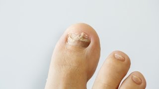 How to prevent and treat nail fungus [upl. by Onstad]