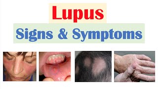 Lupus Signs amp Symptoms amp Why They Occur  Skin Joints Organ Systems [upl. by Yrrej]