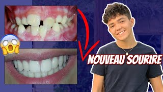 TOUT SUR MES DENTS évolution douleurs [upl. by Agemo]