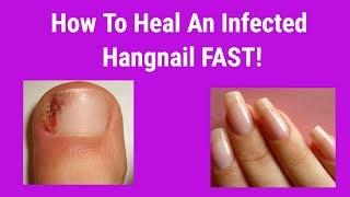 How To Heal An Infected Hangnail FAST [upl. by Christin970]