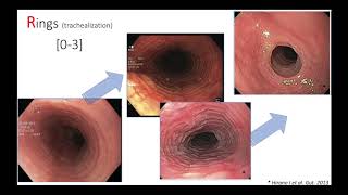 👉 High Eosinophil Count  Causes  By Dr Rupal Shorts [upl. by Shena]