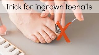 How to Fix Ingrown Toenails Easily [upl. by Fulviah]