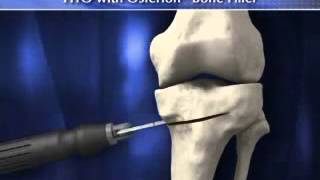 Breaking the Nose  Rhinoplasty Animation  Osteotomy [upl. by Emor]